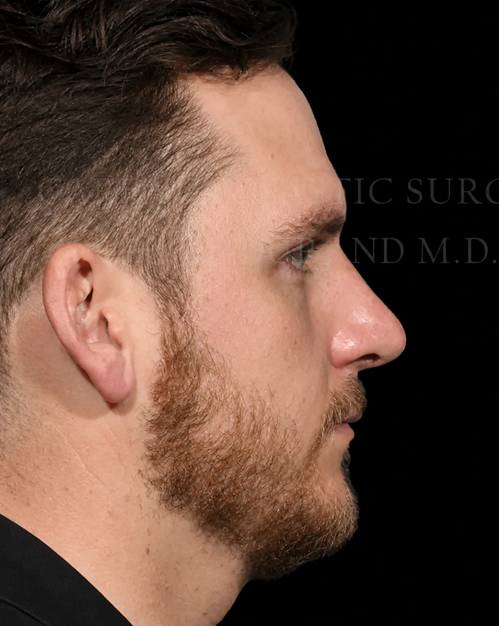 Rhinoplasty after