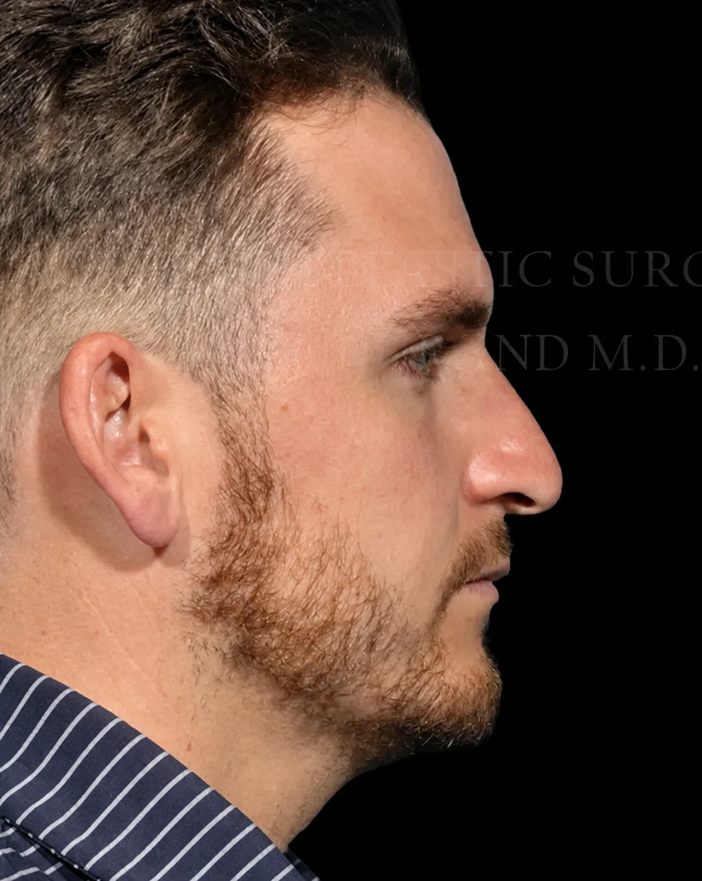 Rhinoplasty before