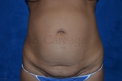 Tummy-Tuck-Case-3063 | Before Tummy Tuck