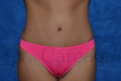 Tummy-Tuck-Case-3063 | After Tummy Tuck