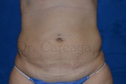 Tummy-Tuck-Case-3085 | Before Tummy Tuck