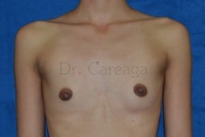 Breast-Augmentation-Case-3199 | Before Breast Augmentation