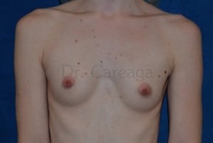 Breast-Augmentation-Case-3285 | Before Breast Augmentation