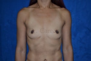 Breast-Augmentation-Case-3296 | Before Breast Augmentation