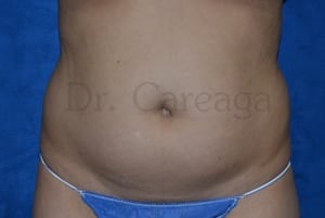 Tummy-Tuck-Case-3382 | Before Tummy Tuck