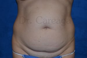 Tummy-Tuck-Case-3393 | Before Tummy Tuck