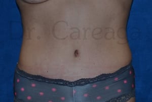 Tummy-Tuck-Case-3393 | After Tummy Tuck