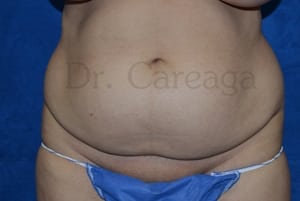 Tummy-Tuck-Case-3415 | Before Tummy Tuck