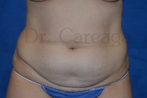 Tummy-Tuck--Case-3426 | Before Tummy Tuck