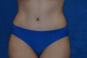 Tummy-Tuck--Case-3426 | After Tummy Tuck