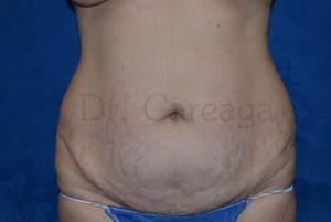 Tummy-Tuck-Case-3437 | Before Tummy Tuck