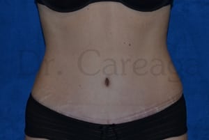 Tummy-Tuck-Case-3437 | After Tummy Tuck