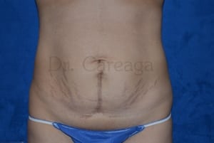 Tummy-Tuck-Case-3448 | Before Tummy Tuck