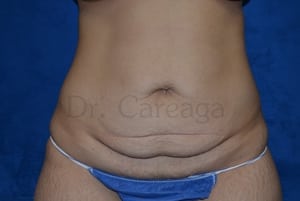 Tummy-Tuck-Case-3459 | Before Tummy Tuck