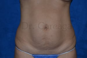 Tummy-Tuck-Case-3470 | Before Tummy Tuck