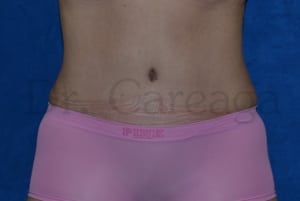 Tummy-Tuck-Case-3470 | After Tummy Tuck