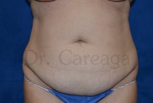 Tummy-Tuck-Case-3481 | Before Tummy Tuck