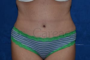 Tummy-Tuck-Case-3481 | After Tummy Tuck