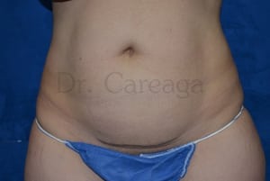 Tummy-Tuck-Case-3492 | Before Tummy Tuck