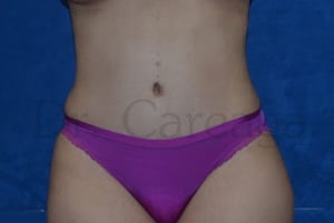 Tummy-Tuck-Case-3492 | After Tummy Tuck