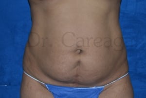 Tummy-Tuck-Case-3503 | Before Tummy Tuck
