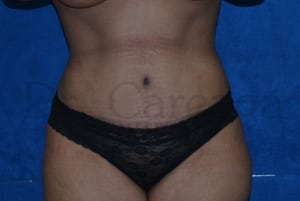 Tummy-Tuck-Case-3503 | After Tummy Tuck