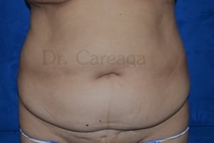 Tummy-Tuck-Case-3514 | Before Tummy Tuck