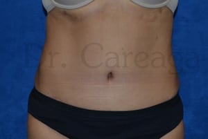 Tummy-Tuck-Case-3514 | After Tummy Tuck