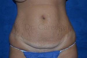 Tummy-Tuck-Case-3525 | Before Tummy Tuck