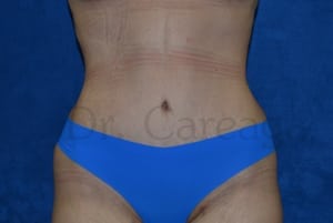 Tummy-Tuck-Case-3525 | After Tummy Tuck