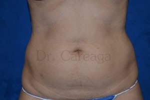 Tummy-Tuck-Case-3547 | Before Tummy Tuck