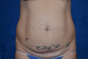 Tummy-Tuck-Case-3558 | Before Tummy Tuck