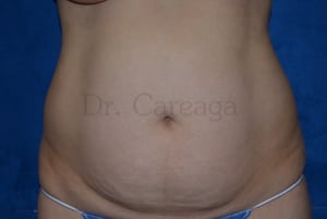 Tummy-Tuck-Case-3591 | Before Tummy Tuck