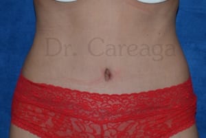 Tummy-Tuck-Case-3591 | After Tummy Tuck