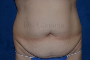 Tummy-Tuck-Case-3602 | Before Tummy Tuck
