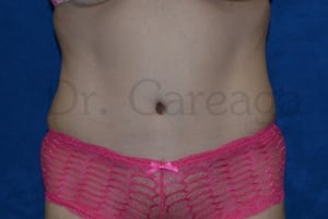 Tummy-Tuck-Case-3602 | After Tummy Tuck