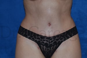 Tummy-Tuck-Case-3613 | After Tummy Tuck