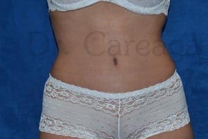 Tummy-Tuck-Case-3624 | After Tummy Tuck