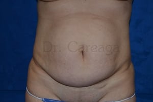 Tummy-Tuck-Case-3635 | Before Tummy Tuck