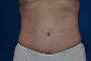 Tummy-Tuck-Case-3635 | After Tummy Tuck