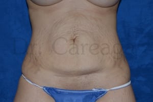 Tummy-Tuck-Case-3646 | Before Tummy Tuck