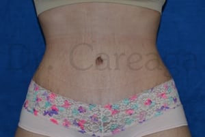 Tummy-Tuck-Case-3646 | After Tummy Tuck