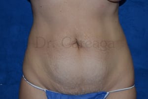 Tummy-Tuck-Case-3657 | Before Tummy Tuck