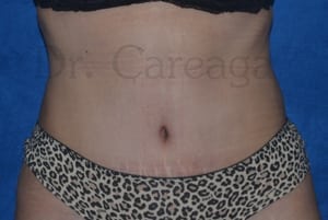 Tummy-Tuck-Case-3657 | After Tummy Tuck