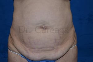 Tummy-Tuck-Case-3668 | Before Tummy Tuck