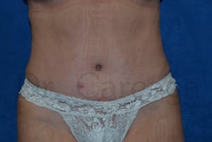 Tummy-Tuck-Case-3668 | After Tummy Tuck