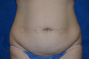 Tummy-Tuck-Case-3679 | Before Tummy Tuck
