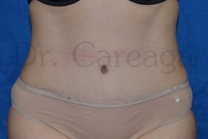 Tummy-Tuck-Case-3679 | After Tummy Tuck