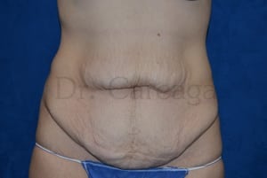 Tummy-Tuck--Case-3690 | Before Tummy Tuck
