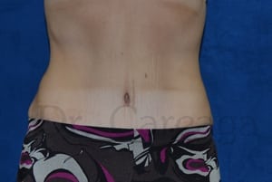 Tummy-Tuck--Case-3690 | After Tummy Tuck